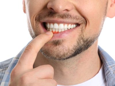 نزيف اللثة: الأسباب والعلاج