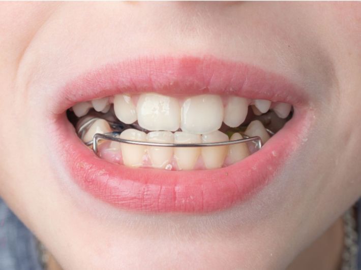 تقدم الفك السفلي عند الأطفال