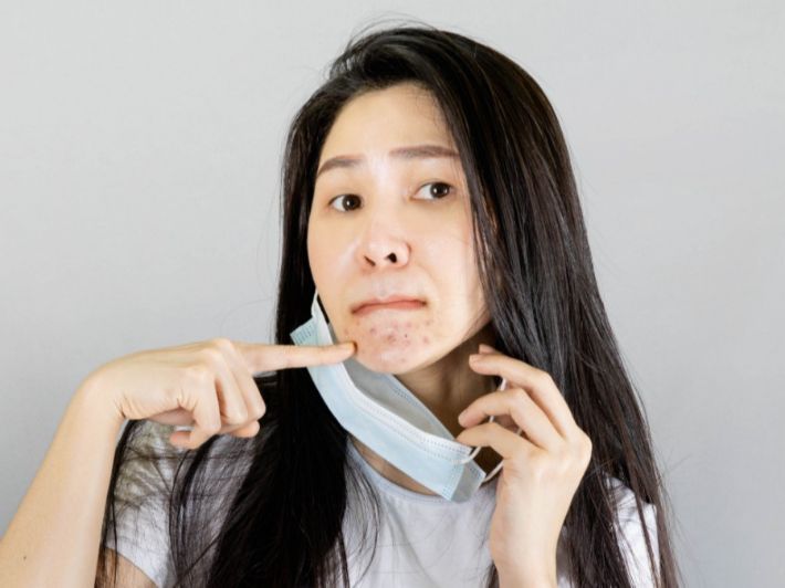 كيفية التخلص من آثار الحبوب في الذقن