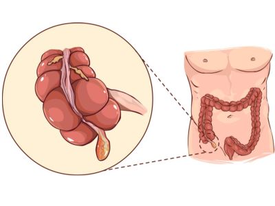 أين توجد الزائدة الدودية؟