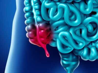 التهاب الزائدة الدودية: الأعراض، الأسباب والعلاج
