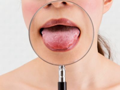 تقرحات اللسان: لماذا وماذا تفعل؟