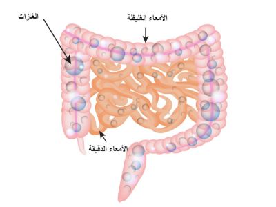 غازات القولون: الأعراض، الأسباب والعلاج