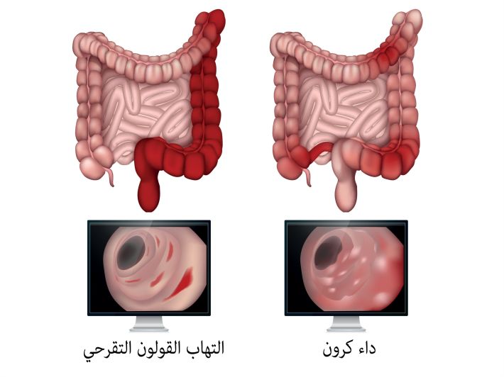 مرض التهاب الأمعاء الأنواع والأسباب والعلاج صحة الجهاز الهضمي