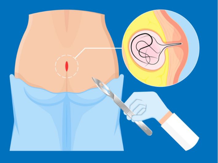 الناسور الشعري: الأعراض، الأسباب والعلاج