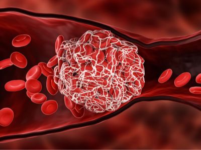 أنواع الجلطات