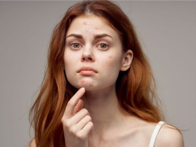 علاج الحبوب في الذقن