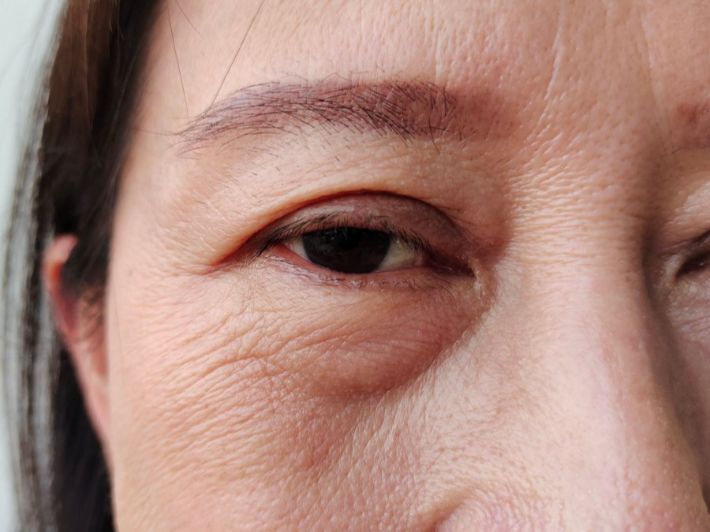 علاج تساقط الرموش بسبب الثعلبة