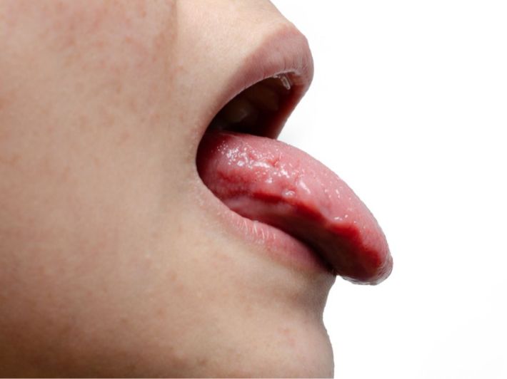 أسباب التهاب اللسان من الأطراف