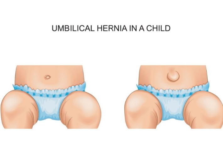 أسباب الفتق الأربي عند الأطفال