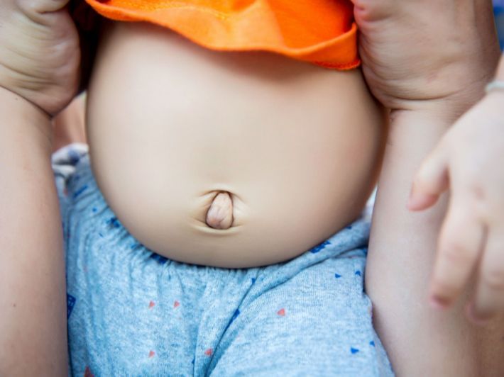 أسباب الفتق السري عند الأطفال