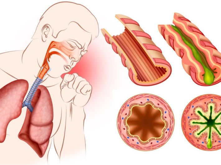 أسباب ضيق القصبة الهوائية
