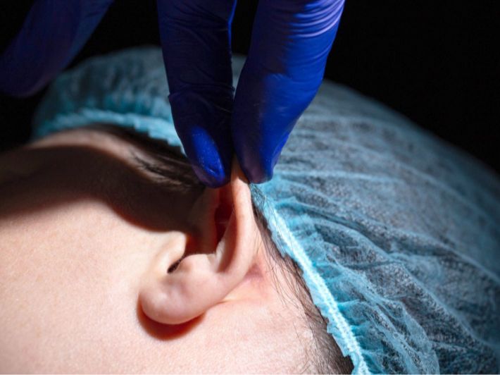 أنواع عمليات تجميل الأذن البارزة