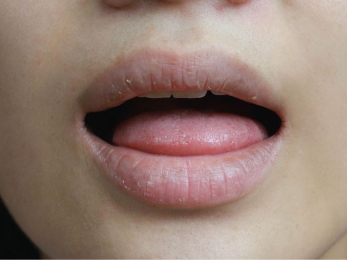 الأمراض التي تسبب مرارة الفم