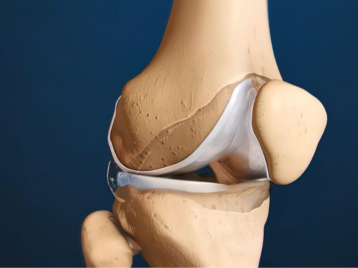 تآكل الغضاريف القطنية