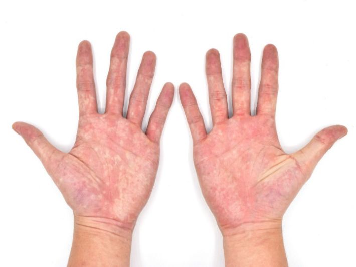 علاج احمرار كف اليدين