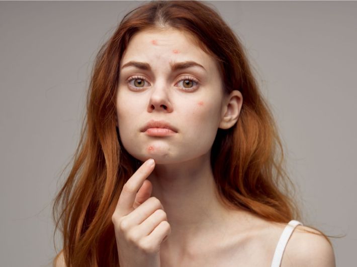 علاج الحبوب في الذقن