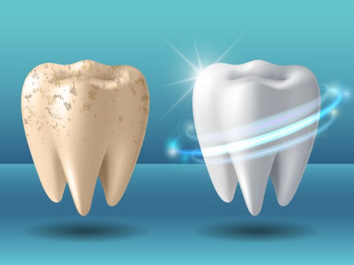 علاج تآكل مينا الأسنان
