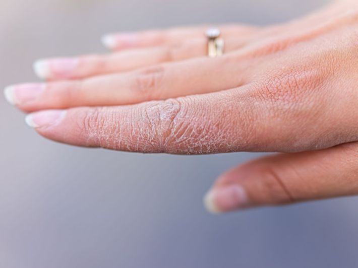 علاج حساسية اليدين من مواد التنظيف