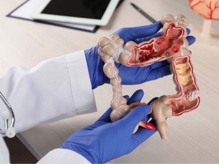 علاج سرطان القولون في المرحلة الثالثة