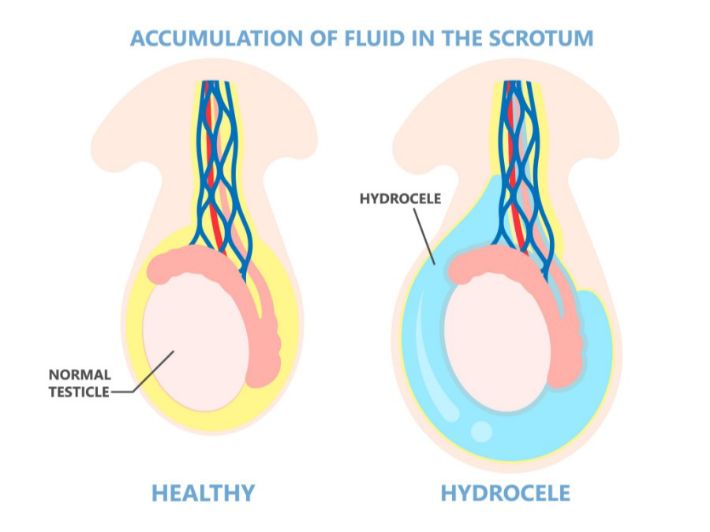 علاج ماء الخصية عند الأطفال