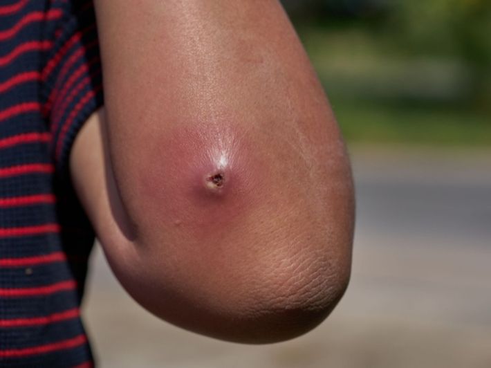 مضاعفات الخراج