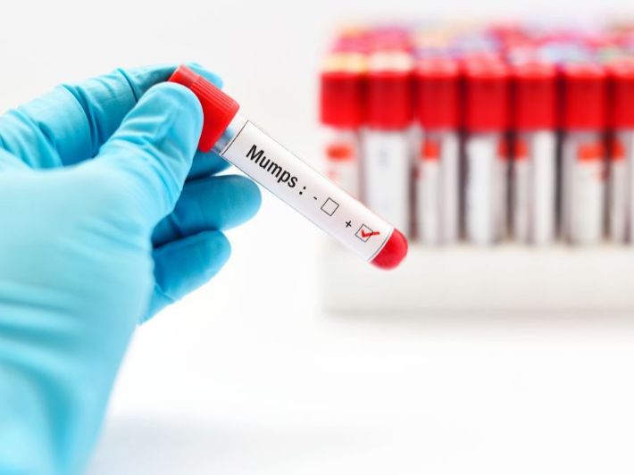 أعراض النكاف