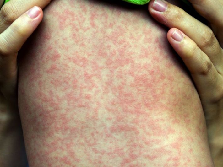 الحصبة عند الاطفال