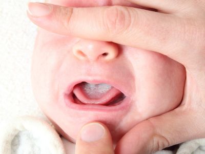 ظهور حبوب بيضاء في فم الرضيع: الأسباب والعلاج ظهور حبوب بيضاء في فم الرضيع: الأسباب والعلاج
