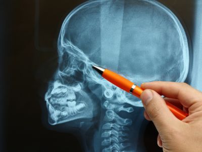 ما هي متلازمة أبرت؟ ما هي متلازمة أبرت؟