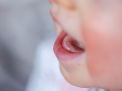 ما هي متلازمة بيير روبن؟ ما هي متلازمة بيير روبن؟