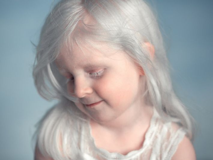 كل ما يهمّك عن البرص عند الأطفال