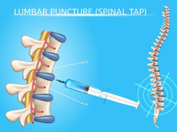 أضرار سحب عينة من النخاع الشوكي للأطفال