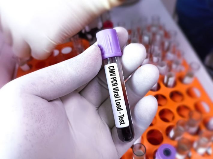 تحليل الأجسام المضادة لفيروس مضخم الخلايا (CMV)