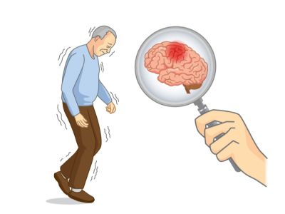 تمارين الشلل الرعاشي