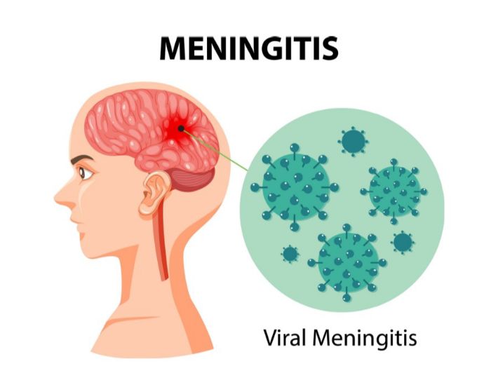 الفرق بين التهاب السحايا والتهاب الدماغ الياباني