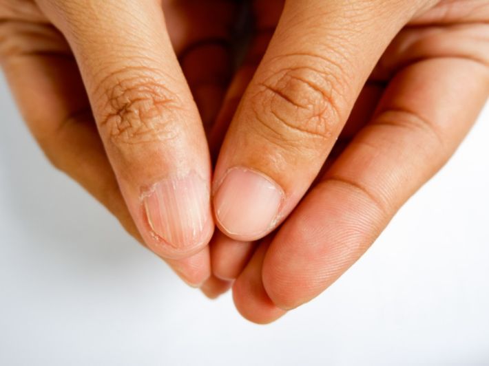 هل تشقق الاظافر نقص فيتامينات ؟