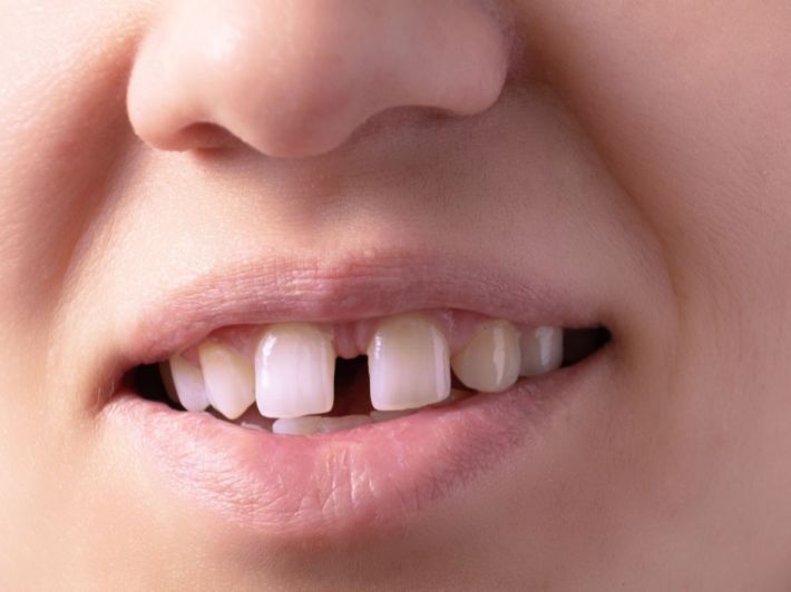 علاج الفلجة بين الأسنان الأمامية