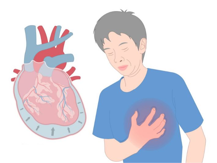 تضخم عضلة القلب: التشخيص والعلاج