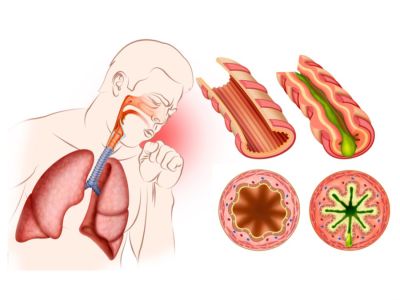ما هو صفير الصدر وما علاجه؟