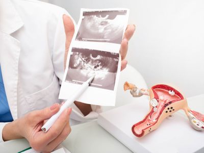 تكيس المبايض والحمل بتوأم تكيس المبايض والحمل بتوأم