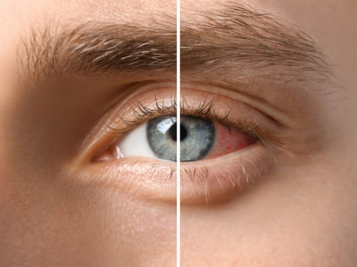 تشخيص التهاب القزحية