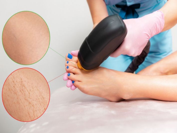 أسباب عدم سقوط الشعر بعد الليزر