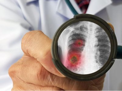 الدليل الشامل لمتلازمة الشرق الأوسط التنفسية